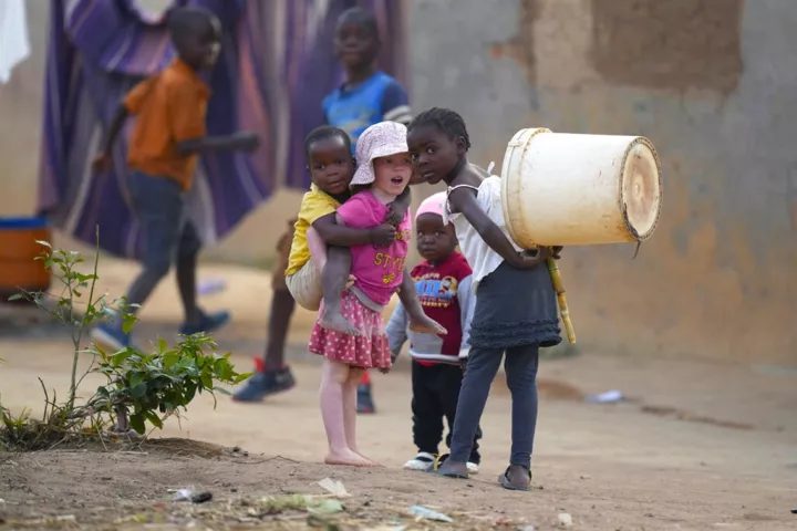 Ζιμπάμπουε: Τουλάχιστον 157 παιδιά πέθαναν από ιλαρά